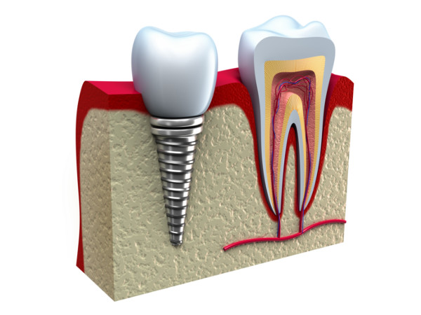 Dental Implants